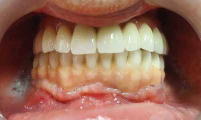 Sinus lifting, implanturi și adiții osoase