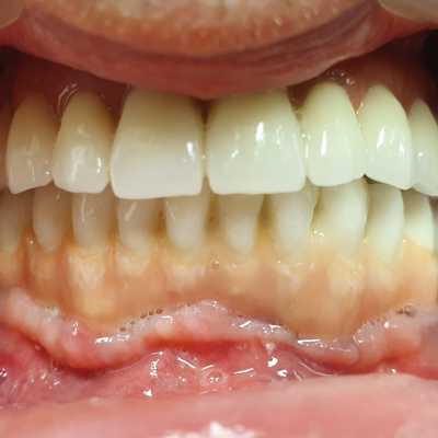 Sinus lifting, implanturi și adiții osoase