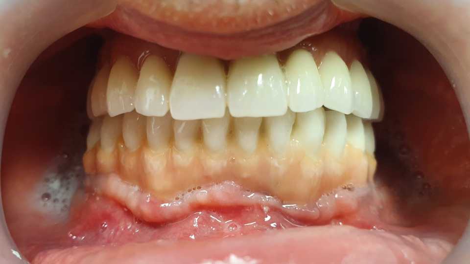 Sinus lifting, implanturi și adiții osoase