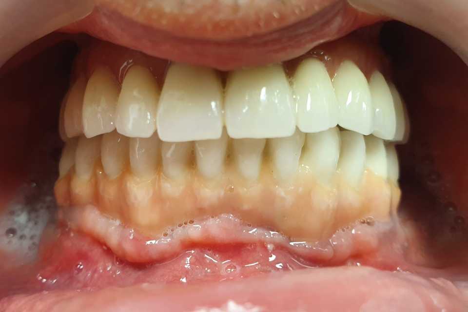 Sinus lifting, implanturi și adiții osoase