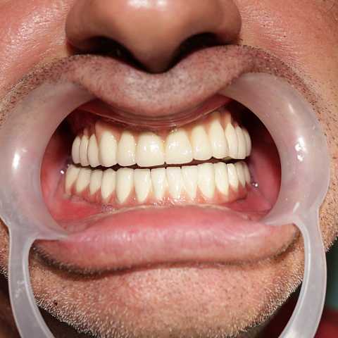 Implanturi dentare și proteză metalo-ceramică