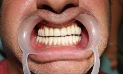 Implanturi dentare și proteză metalo-ceramică