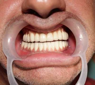 Implanturi dentare și proteză metalo-ceramică