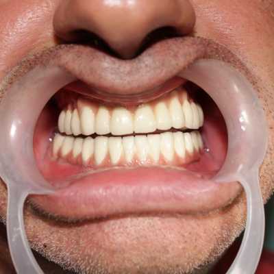 Implanturi dentare și proteză metalo-ceramică