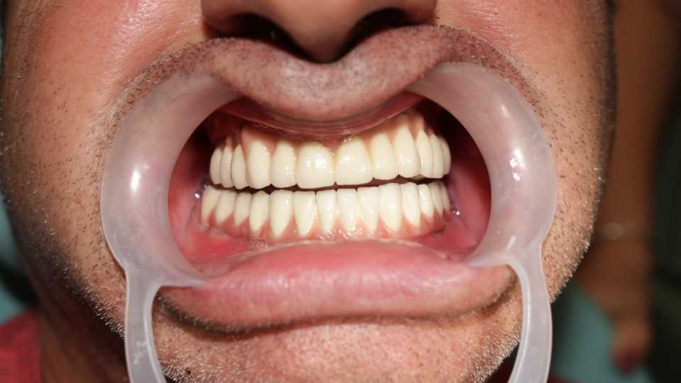 Implanturi dentare și proteză metalo-ceramică