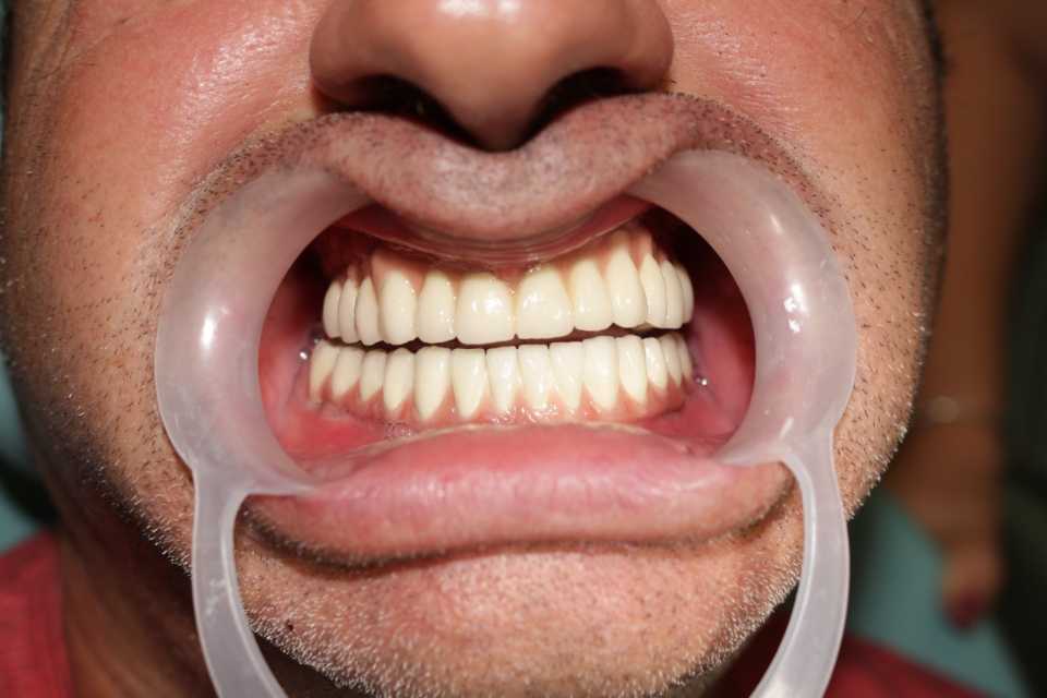 Implanturi dentare și proteză metalo-ceramică