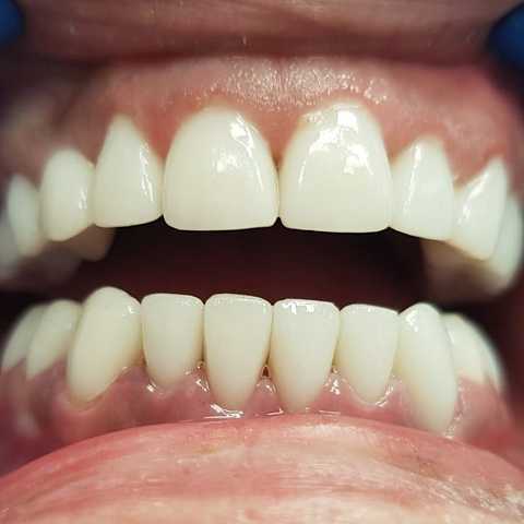Coroane ceramice Emax