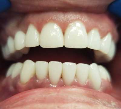 Coroane ceramice Emax