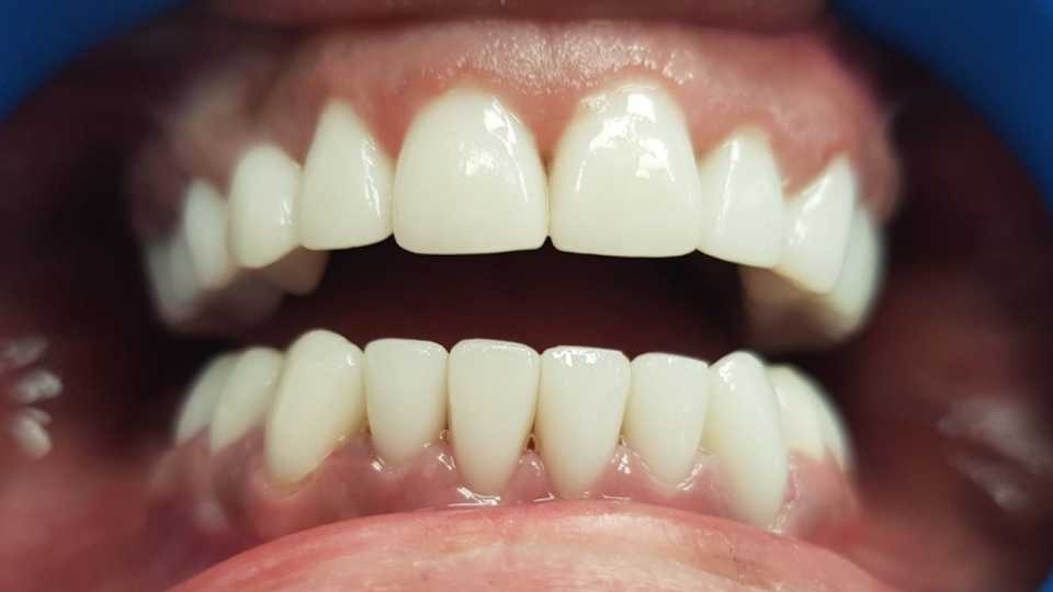 Coroane ceramice Emax