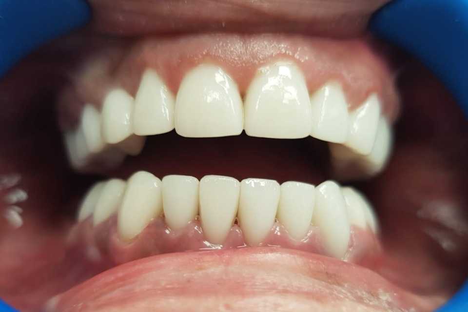 Coroane ceramice Emax