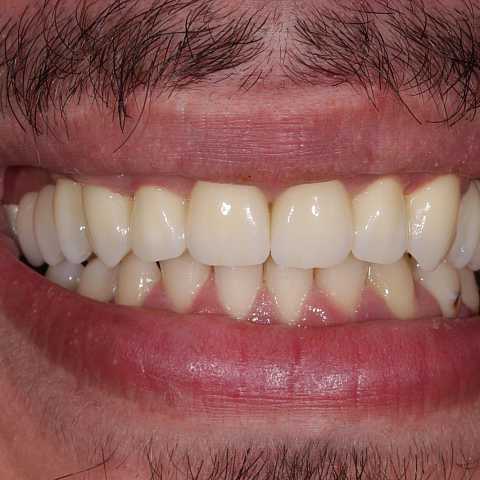 Coroane și punți din ceramică pe substrat de zirconiu