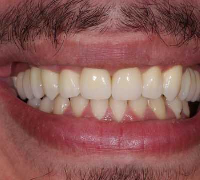 Coroane și punți din ceramică pe substrat de zirconiu