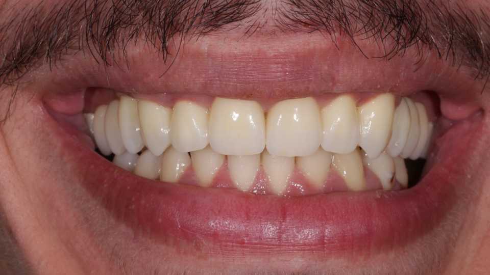 Coroane și punți din ceramică pe substrat de zirconiu