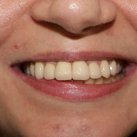 Coroane din ceramică pe suport de zirconiu