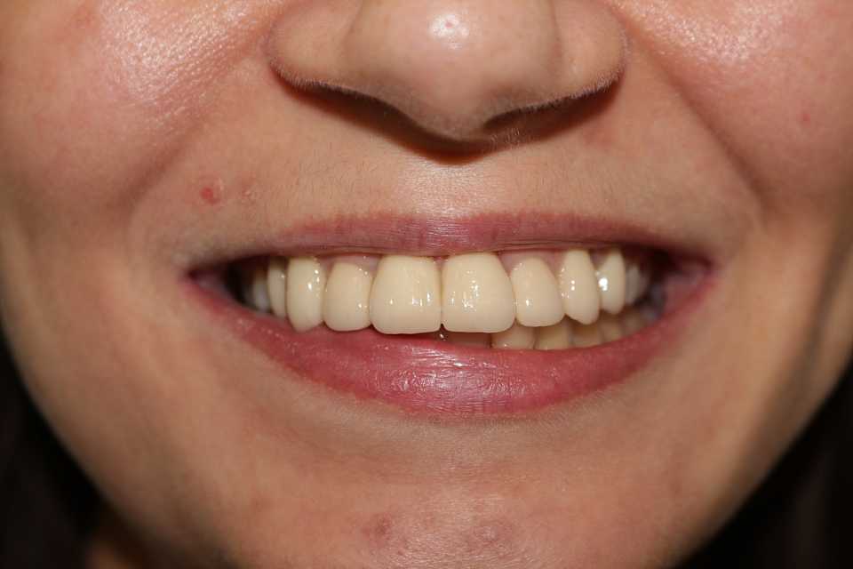 Coroane din ceramică pe suport de zirconiu