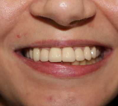 Coroane din ceramică pe suport de zirconiu