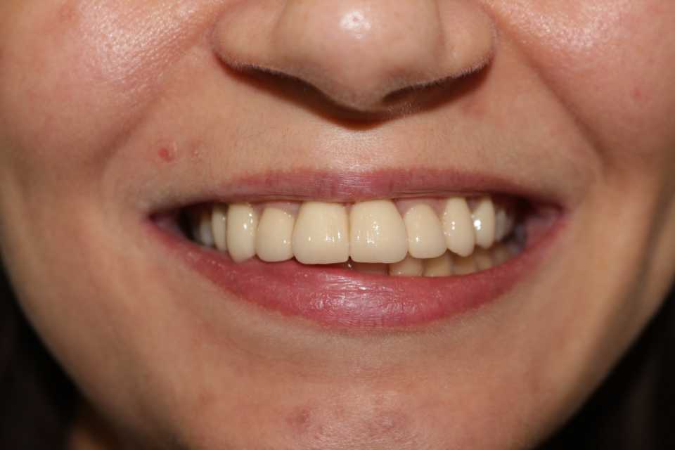 Coroane din ceramică pe suport de zirconiu