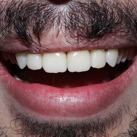 Restaurari coronare din zirconiu