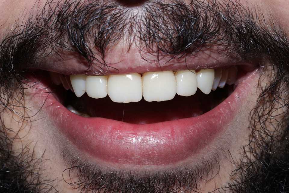 Restaurari coronare din zirconiu
