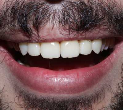 Restaurari coronare din zirconiu