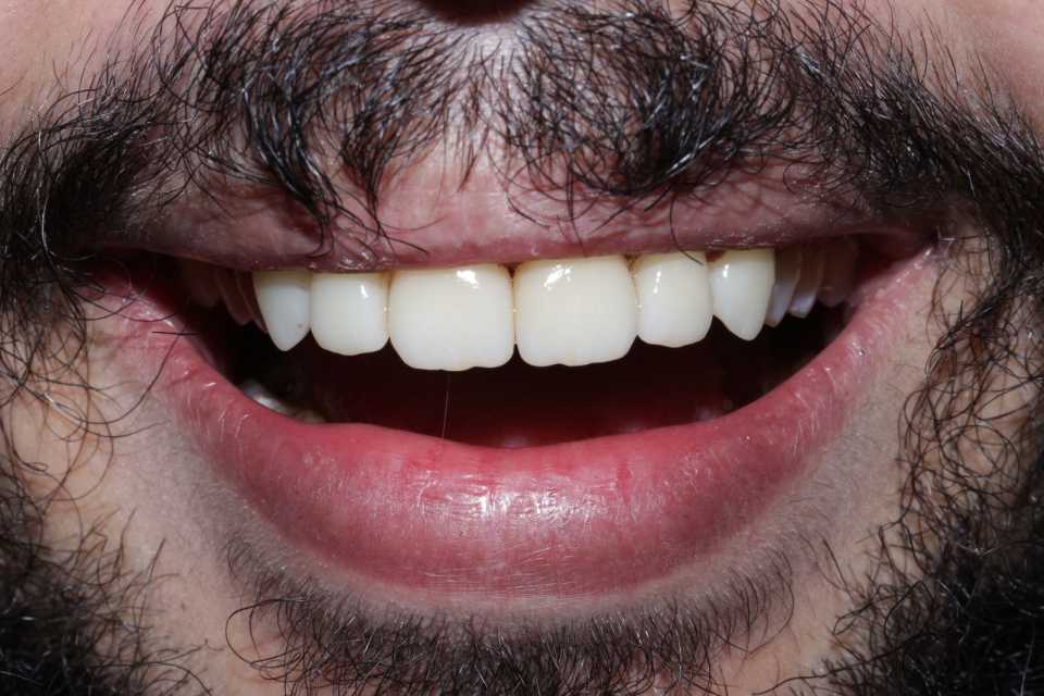 Restaurari coronare din zirconiu