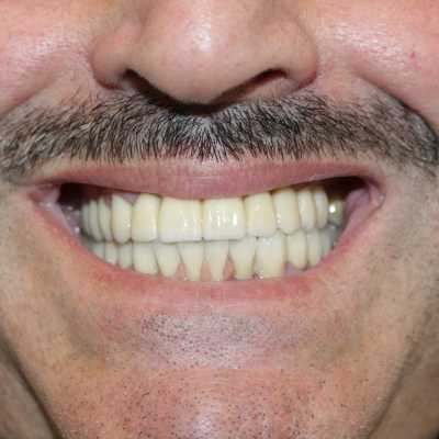 Implanturi și protetică