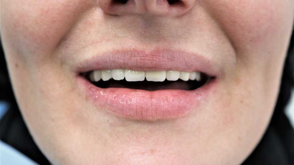 Implanturi Megagen și coroane metalo-ceramice