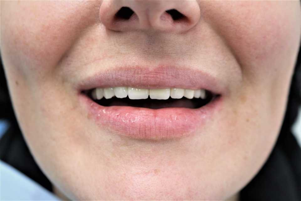 Implanturi Megagen și coroane metalo-ceramice