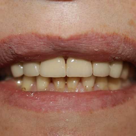 Coroane ceramice pe suport de zirconiu