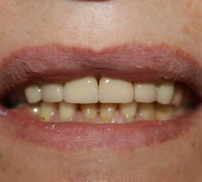 Coroane ceramice pe suport de zirconiu