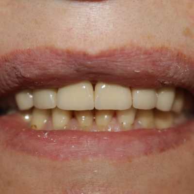 Coroane ceramice pe suport de zirconiu