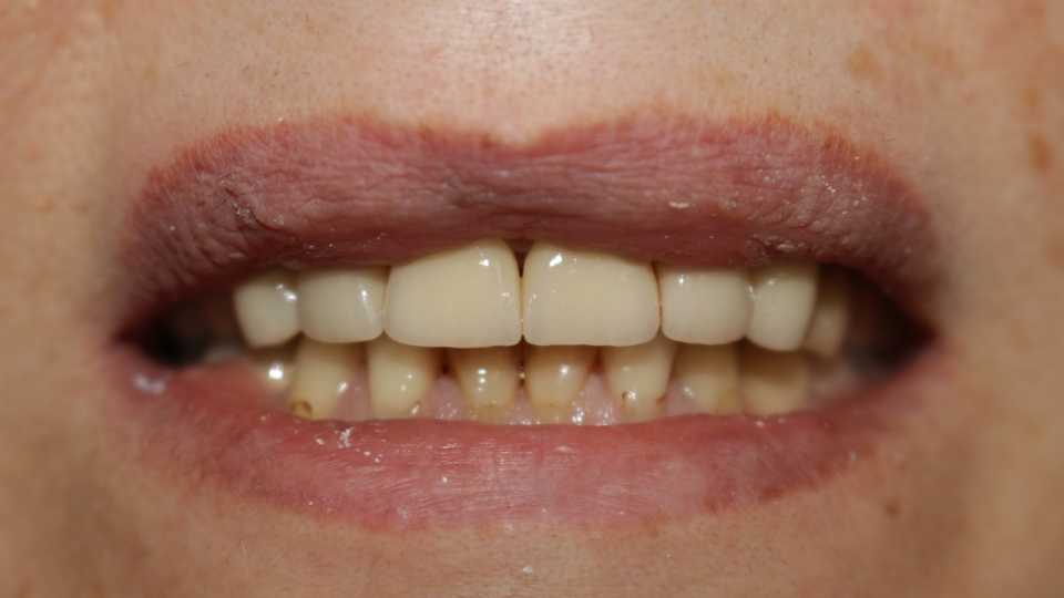 Coroane ceramice pe suport de zirconiu