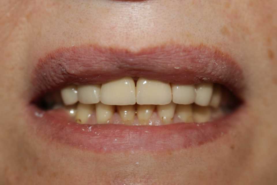 Coroane ceramice pe suport de zirconiu