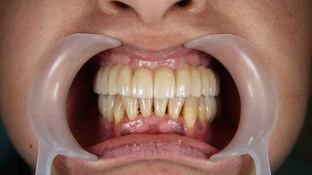 Implant dentar MegaGen AnyRidge