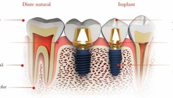 Implant dentar MegaGen AnyRidge