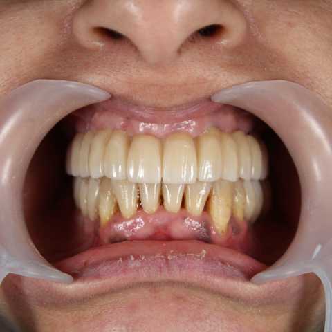 Implant dentar MegaGen AnyRidge