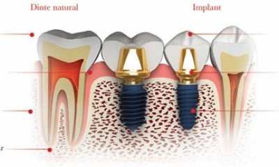 Implant dentar MegaGen AnyRidge