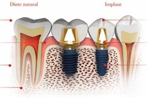 Implant dentar MegaGen AnyRidge