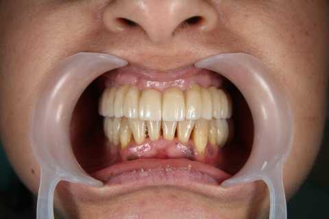 Implant dentar MegaGen AnyRidge