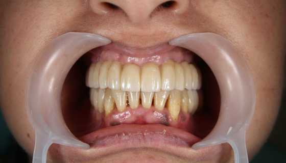 Implant dentar MegaGen AnyRidge