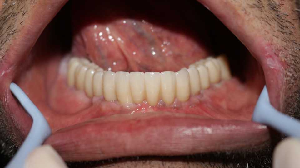 Lucrare protetică fixă pe 6 implanturi