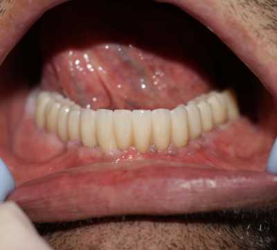 Lucrare protetică fixă pe 6 implanturi