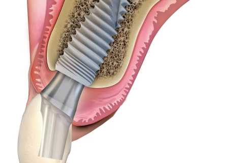 Implant dentar Paltop