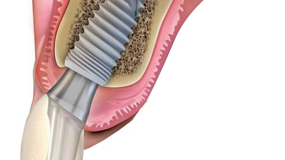 Implant dentar Paltop