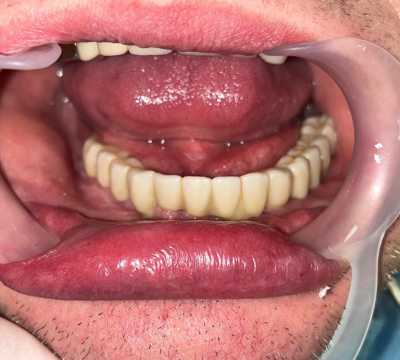 Lucrare fixă înșurubabilă pe implanturi