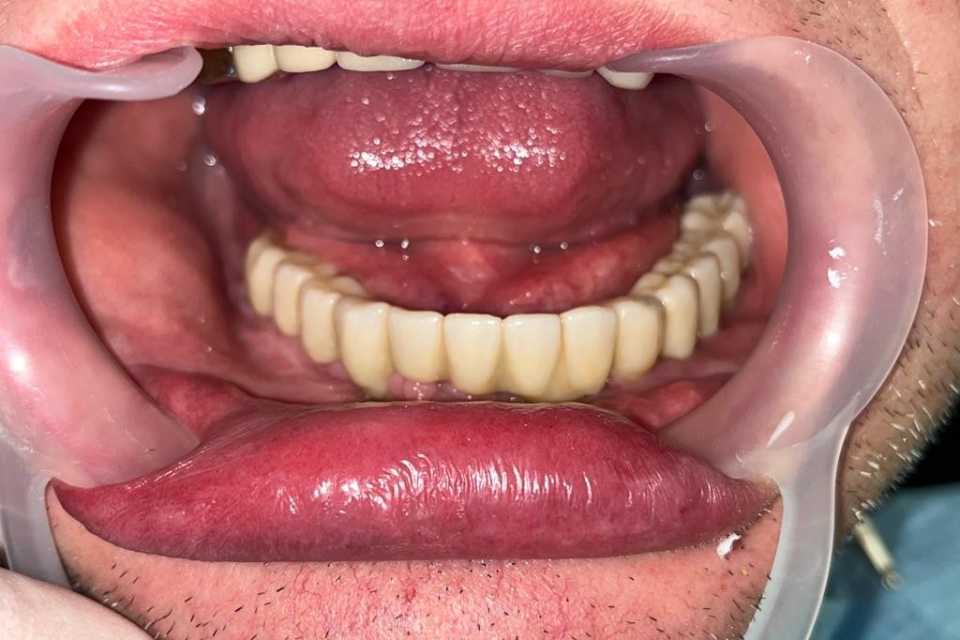 Lucrare fixă înșurubabilă pe implanturi