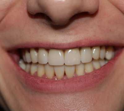 Fațete dentare E-max