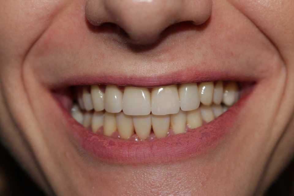 Fațete dentare E-max