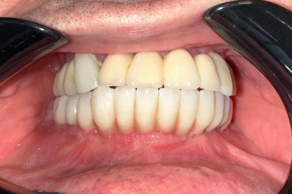 Lucrări protetice fixe pe implanturi Paltop