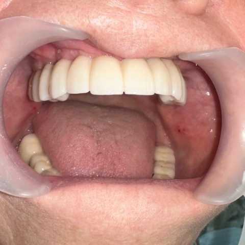Lucrare dentară protetică fixă din ceramica pe zirconiu